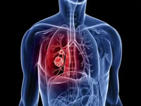 【张医“话”健康】肺癌患者该如何正确放疗？
